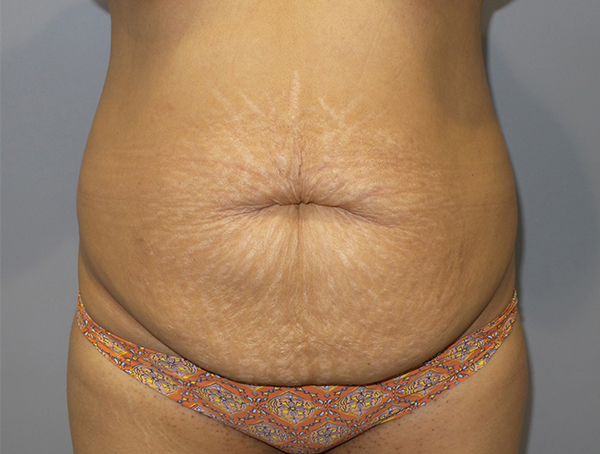 Tummy Tuck Before and After 105 | Sanjay Grover MD FACS