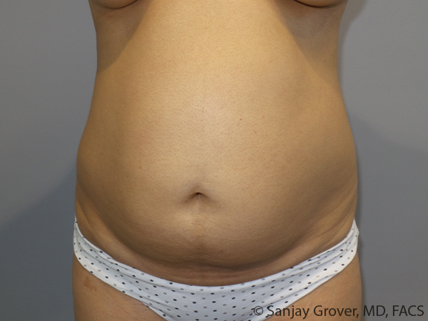 Tummy Tuck Before and After 108 | Sanjay Grover MD FACS