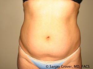 Tummy Tuck Before and After 75 | Sanjay Grover MD FACS