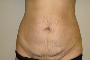 Tummy Tuck Before and After 53 | Sanjay Grover MD FACS