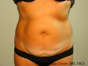 Tummy Tuck Before and After 09 | Sanjay Grover MD FACS