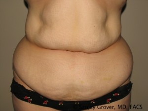 Tummy Tuck Before and After 42 | Sanjay Grover MD FACS