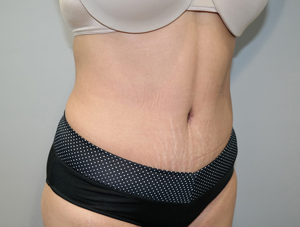 Tummy Tuck Before and After 109 | Sanjay Grover MD FACS