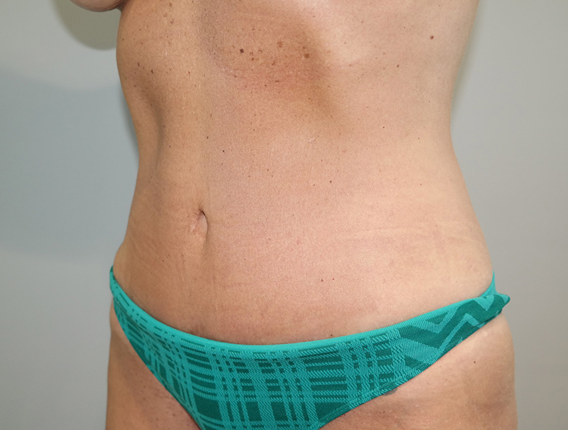 Tummy Tuck Before and After 111 | Sanjay Grover MD FACS