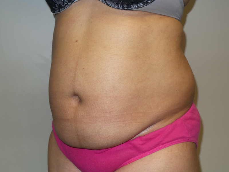 Tummy Tuck Before and After 114 | Sanjay Grover MD FACS