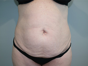Tummy Tuck Before and After 62 | Sanjay Grover MD FACS