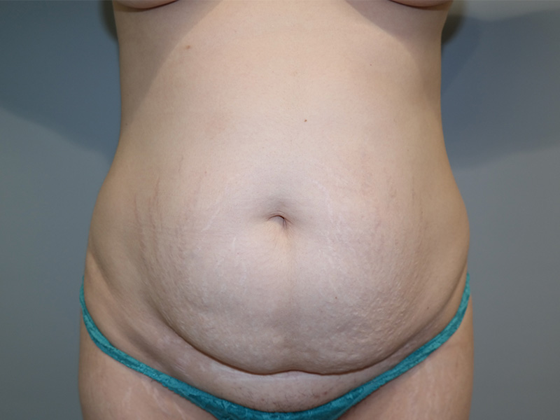 Tummy Tuck Before and After 58 | Sanjay Grover MD FACS
