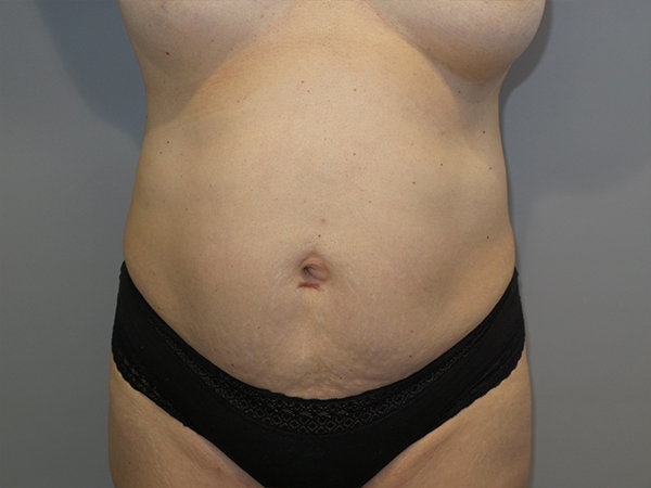 Tummy Tuck Before and After 04 | Sanjay Grover MD FACS