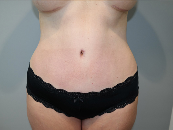 Tummy Tuck Before and After | Sanjay Grover MD FACS