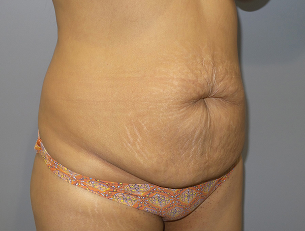 Tummy Tuck Before and After 108 | Sanjay Grover MD FACS