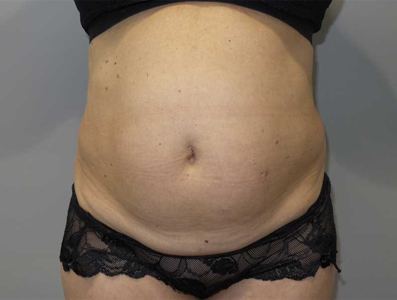 Tummy Tuck Before and After 37 | Sanjay Grover MD FACS