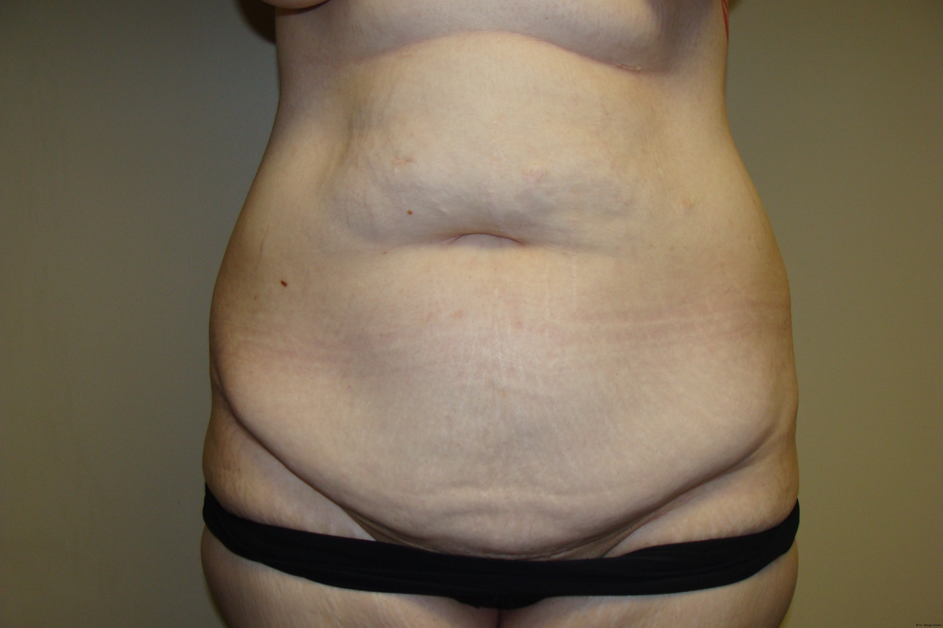 Tummy Tuck Before and After 51 | Sanjay Grover MD FACS