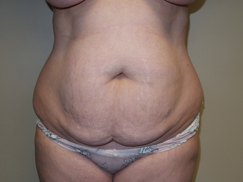 Tummy Tuck Before and After 87 | Sanjay Grover MD FACS