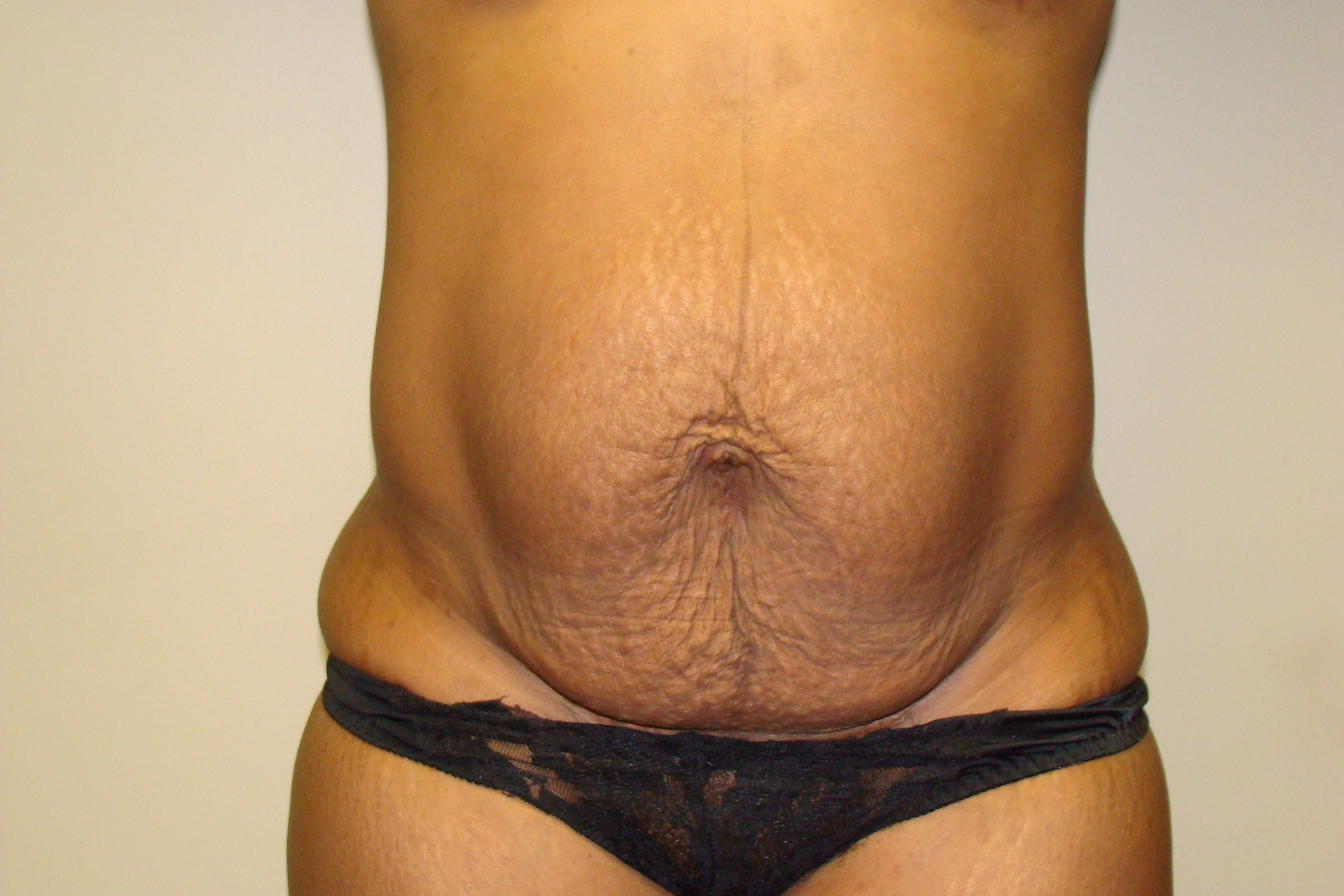 Tummy Tuck Before and After 95 | Sanjay Grover MD FACS