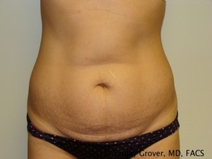 Tummy Tuck Before and After 03 | Sanjay Grover MD FACS