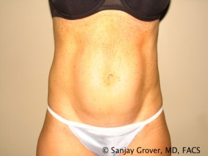 Tummy Tuck Before and After 87 | Sanjay Grover MD FACS