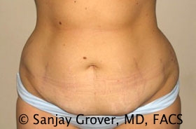 Tummy Tuck Before and After 43 | Sanjay Grover MD FACS