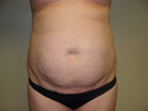 Tummy Tuck Before and After 15 | Sanjay Grover MD FACS