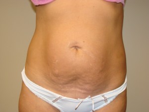 Tummy Tuck Before and After 07 | Sanjay Grover MD FACS