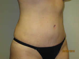 Tummy Tuck Before and After 92 | Sanjay Grover MD FACS