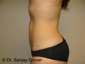 Tummy Tuck Before and After 93 | Sanjay Grover MD FACS