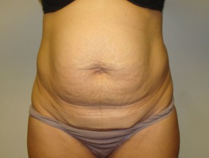 Tummy Tuck Before and After 78 | Sanjay Grover MD FACS