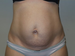 Tummy Tuck Before and After 27 | Sanjay Grover MD FACS