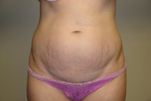 Tummy Tuck Before and After 54 | Sanjay Grover MD FACS