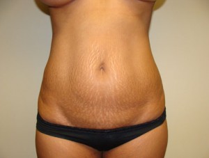 Tummy Tuck Before and After 21 | Sanjay Grover MD FACS