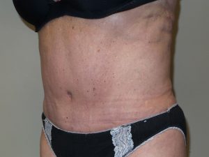 Tummy Tuck Before and After 27 | Sanjay Grover MD FACS