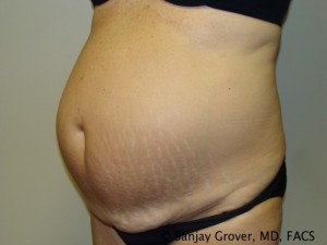 Tummy Tuck Before and After 32 | Sanjay Grover MD FACS