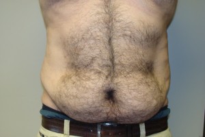 Tummy Tuck Before and After 17 | Sanjay Grover MD FACS