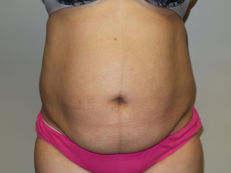Tummy Tuck Before and After 20 | Sanjay Grover MD FACS