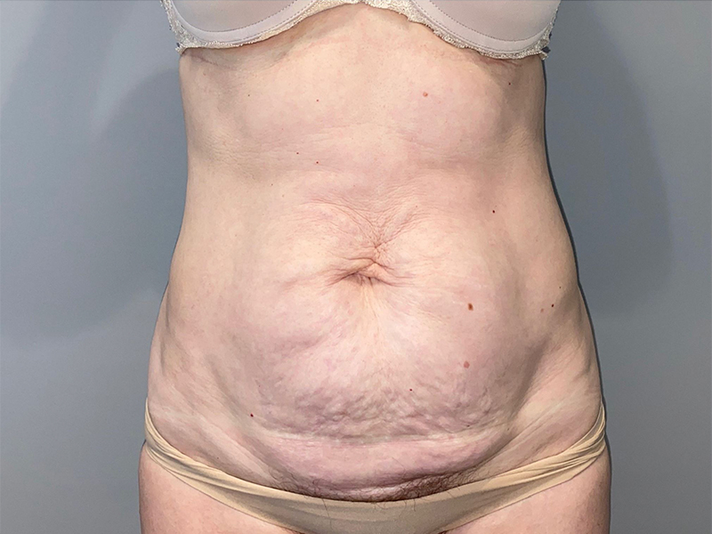 Tummy Tuck Before and After 25 | Sanjay Grover MD FACS