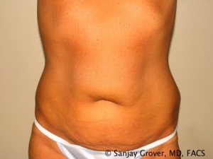 Tummy Tuck Before and After 42 | Sanjay Grover MD FACS