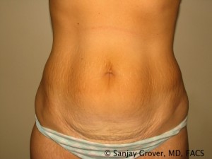 Tummy Tuck Before and After 06 | Sanjay Grover MD FACS