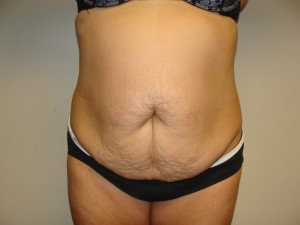 Tummy Tuck Before and After 20 | Sanjay Grover MD FACS