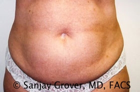 Tummy Tuck Before and After 41 | Sanjay Grover MD FACS