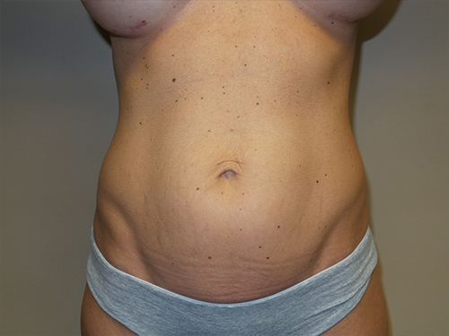 Tummy Tuck Before and After 115 | Sanjay Grover MD FACS