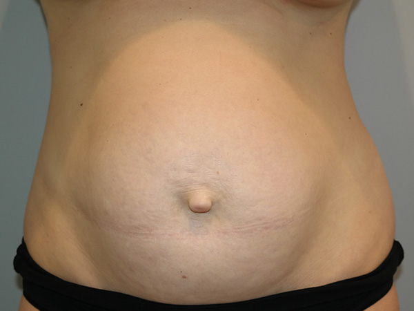 Tummy Tuck Before and After 28 | Sanjay Grover MD FACS