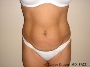 Tummy Tuck Before and After 114 | Sanjay Grover MD FACS