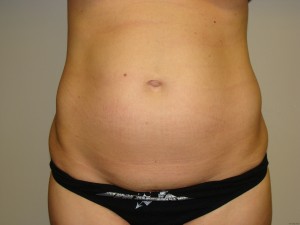 Tummy Tuck Before and After 116 | Sanjay Grover MD FACS