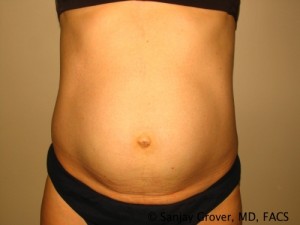 Tummy Tuck Before and After 43 | Sanjay Grover MD FACS