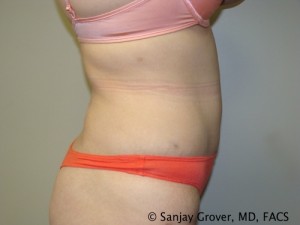 Tummy Tuck Before and After 77 | Sanjay Grover MD FACS