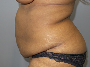 Tummy Tuck Before and After 101 | Sanjay Grover MD FACS