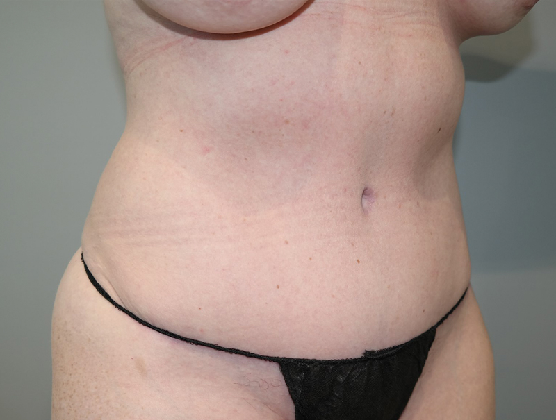 Tummy Tuck Before and After 110 | Sanjay Grover MD FACS