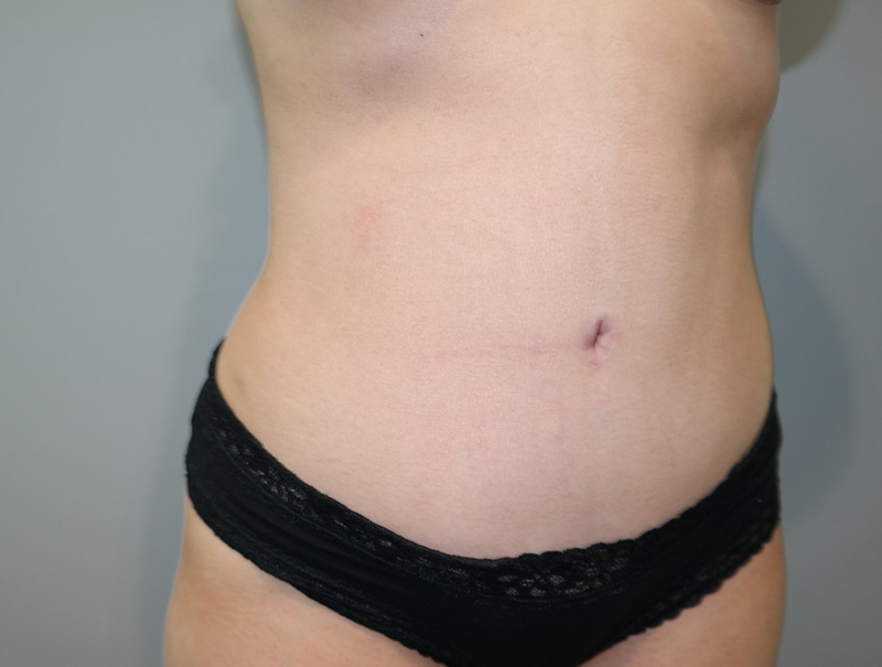 Tummy Tuck Before and After 113 | Sanjay Grover MD FACS