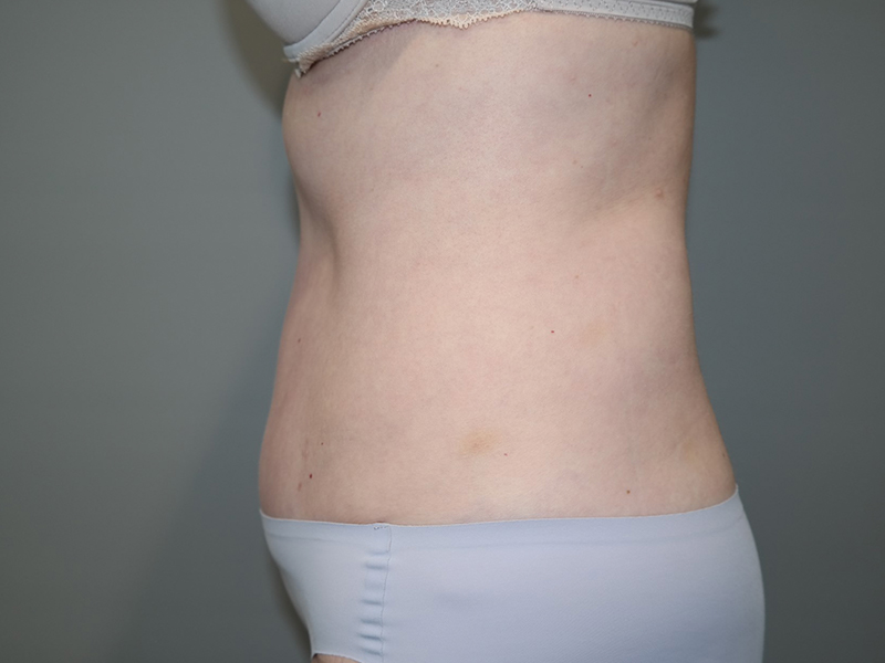 Tummy Tuck Before and After 115 | Sanjay Grover MD FACS