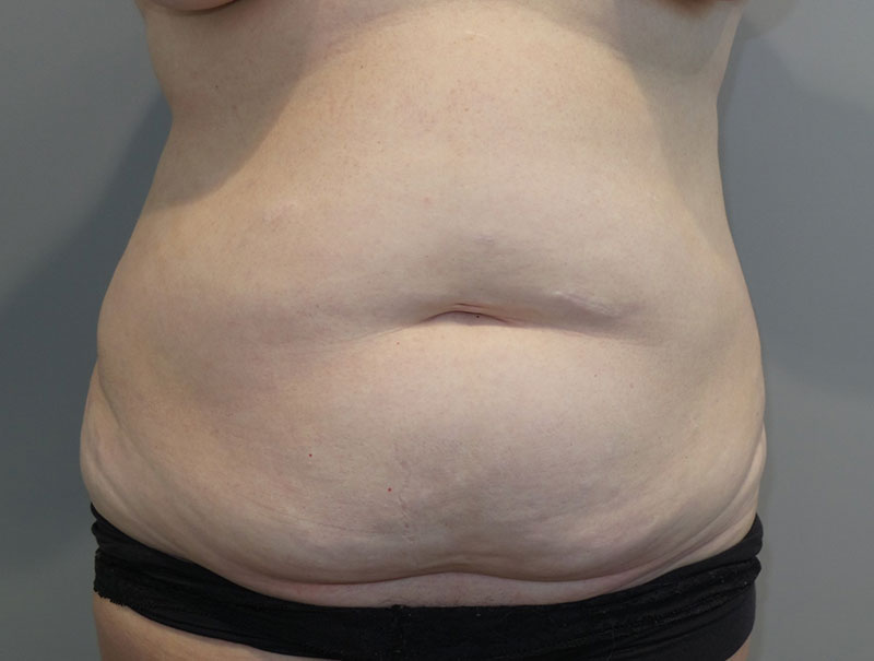 Tummy Tuck Before and After 110 | Sanjay Grover MD FACS