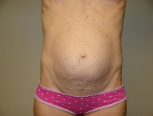 Tummy Tuck Before and After 32 | Sanjay Grover MD FACS